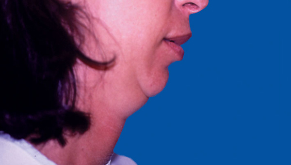 LIPOASPIRATION DU COU