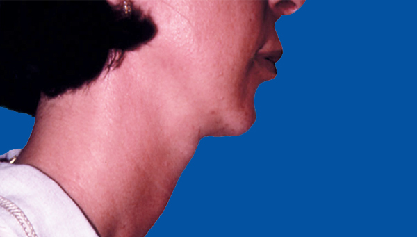 LIPOASPIRATION DU COU