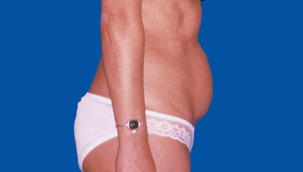LIPOASPIRATION ABDOMEN CHEZ LA FEMME