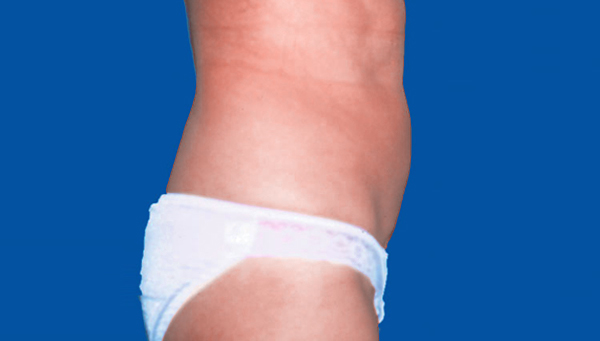 LIPOASPIRATION ABDOMEN CHEZ LA FEMME