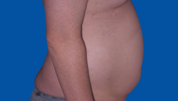 LIPOASPIRATION ABDOMEN CHEZ L’HOMME