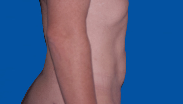 LIPOASPIRATION ABDOMEN CHEZ L’HOMME
