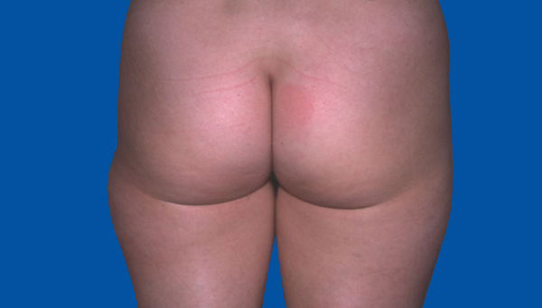 LIPOASPIRATION CULOTTE DE CHEVAL ET INTÉRIEUR DES CUISSES 1