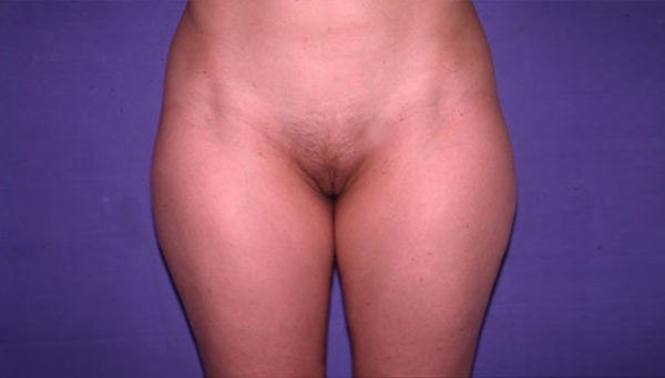 LIPOASPIRATION CULOTTE DE CHEVAL ET INTÉRIEUR DES CUISSES 2